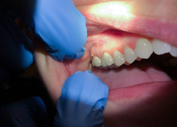 Best Emergency Gum Treatment in Fishhook, AK